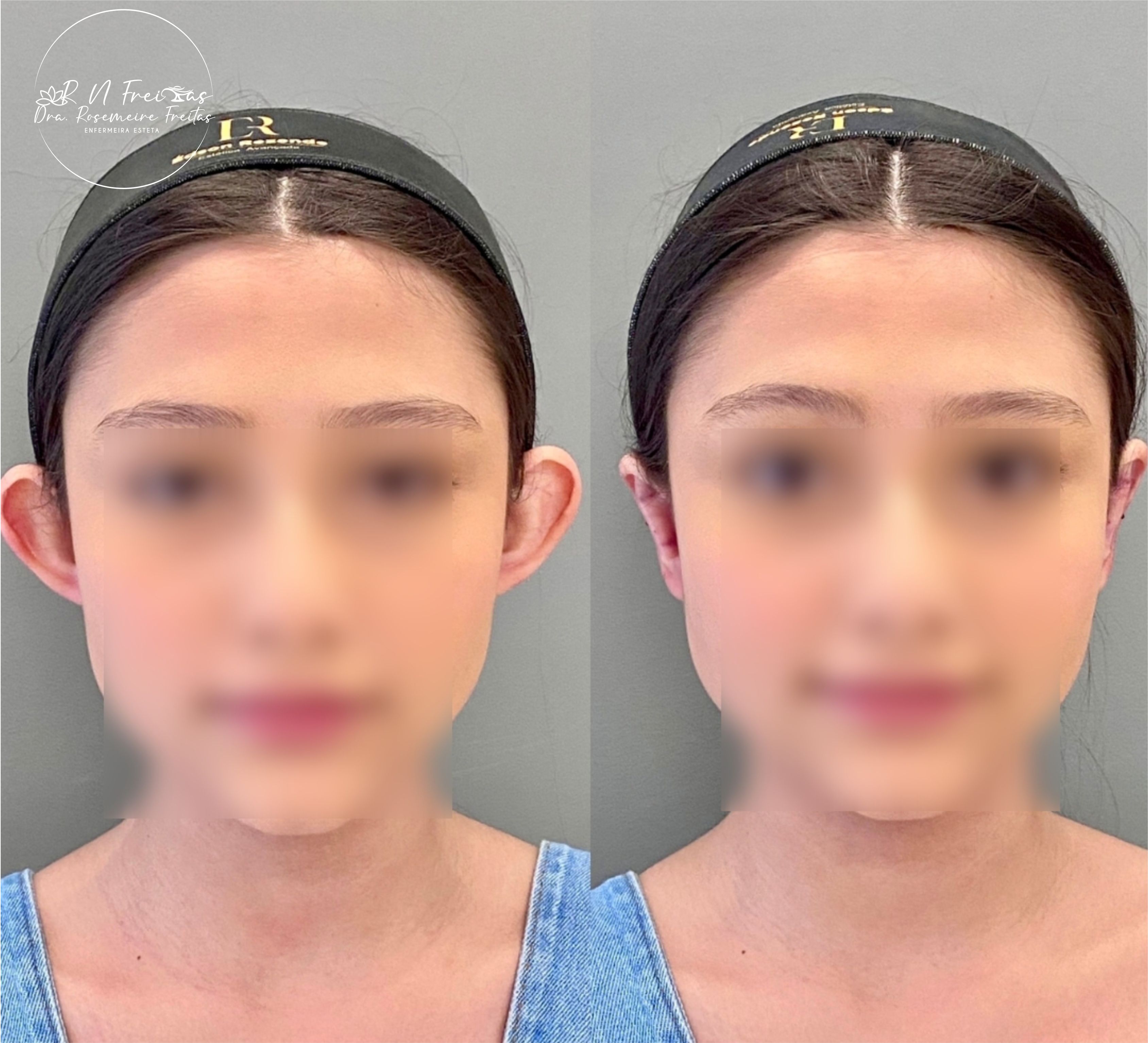 Aparelho de otomodeladora