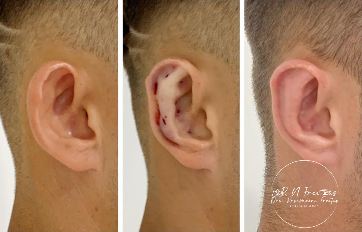 Aparelho de otomodeladora